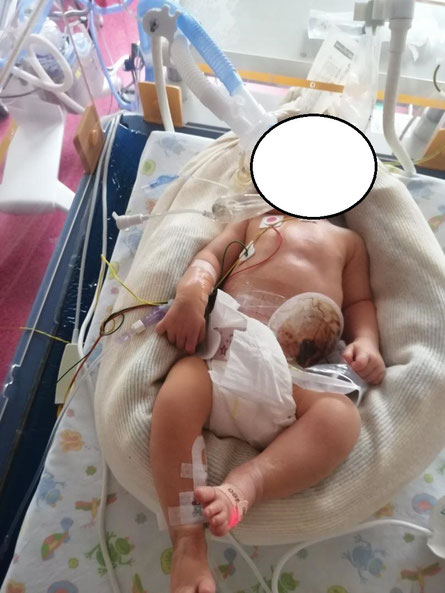 bébé malade, guérisseur bébé par magnétisme, maladie de Hirschsprung