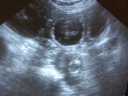 Ultraschallbild eines Föten in der 4. Trächtigkeitswoche