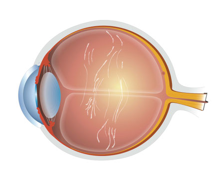 Lästige 'Fliegen' oder Fäden vor dem Auge? - Dr. Michael Steinberger