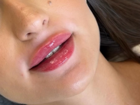 Lippen aufspritzen München