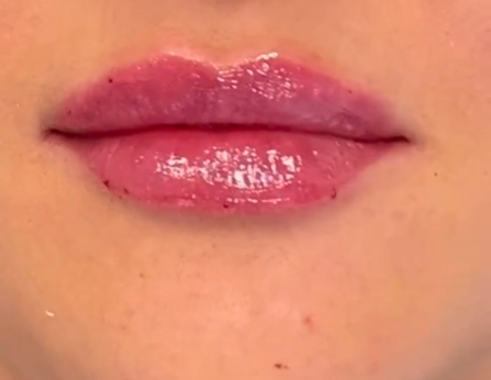 julie horn , russian lips, Lippen aufspritzen München