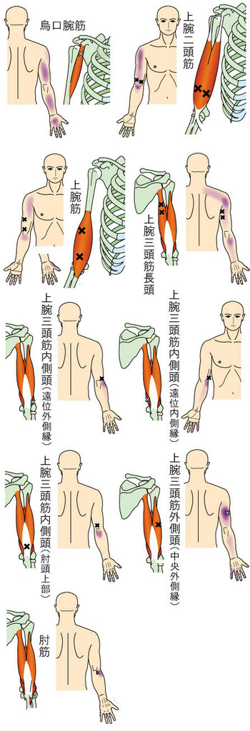 肘・前腕・手に痛みをもたらすトリガーポイント