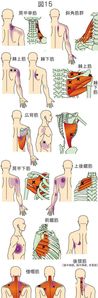 肩甲挙筋　斜角筋　棘上筋　棘下筋　広背筋　肩甲下筋　上後鋸筋　前鋸筋トリガーポイントによる体幹の痛み