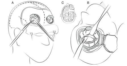 Exemples de topectomie préfrontale. A : topectomie orbitofrontale bilatérale par tréphine B et C : topectomie préfrontale élargie