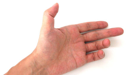ばね指の治療法