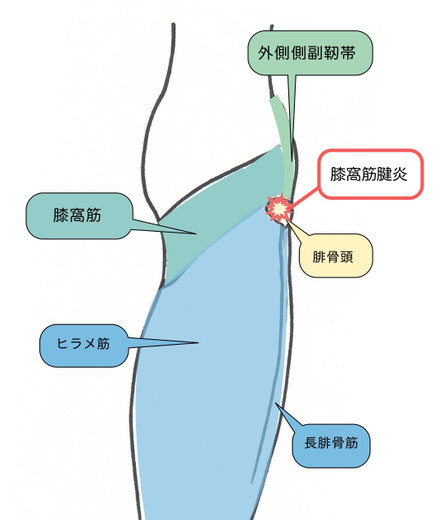 膝窩筋腱炎説明