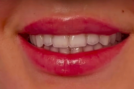 Lippen Filler aufspritzen München