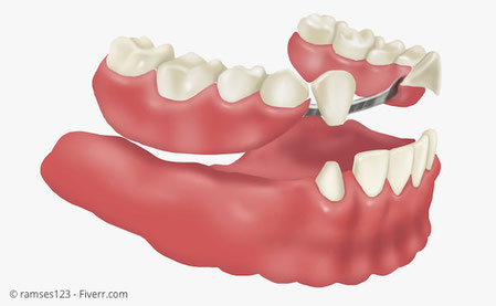 Feste Zahne Statt Teilprothese Dr S Rassaf