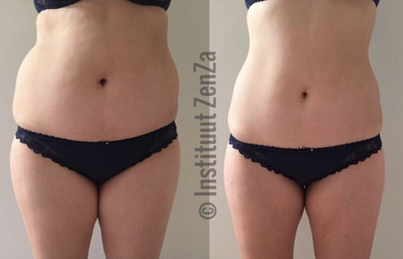 cryolipolyse vet bevriezen coolsculpting cryo instituut zenza hoogstraten