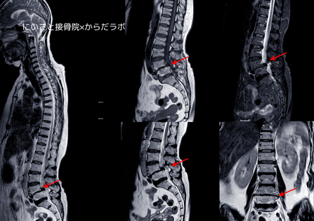 腰椎（ようつい）の変形を伴うような腰痛には医学的な処置が必要
