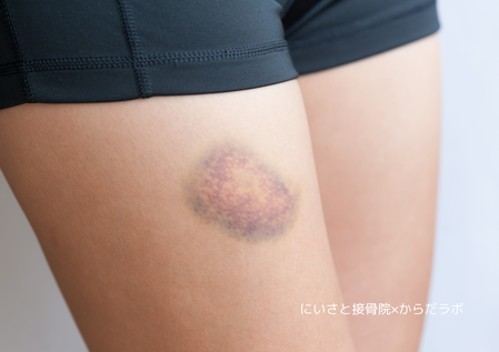 モモカン損傷（大腿部の挫傷）について分かりやすく解説 - にいさと