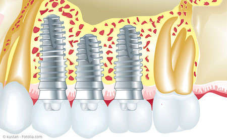 Implantate zum Ersatz fehlender Zähne