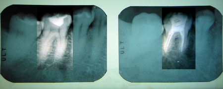 3根管　その５　治療前　　治療後（右）　　患歯ハイライト処理