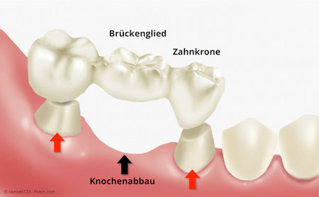 Grafische Darstellung einer Zahnbrücke