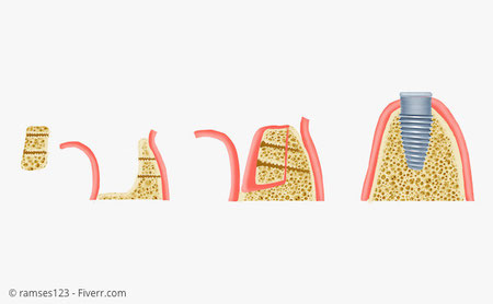 Grafische Darstellung einer Knochenblock-Transplantation