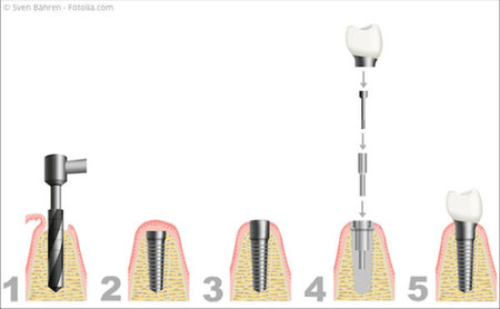 Grafische Darstellung des Ablaufs einer Implantation