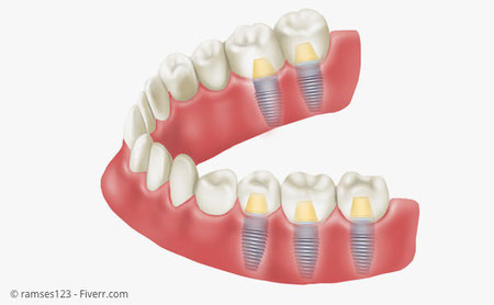 Grafische Darstellung von Implantaten mit Kronen