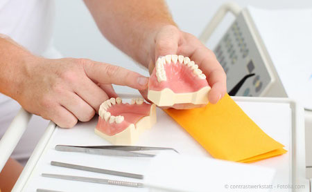 Beratung Implantatbehandlung anhand eines Zahnmodells