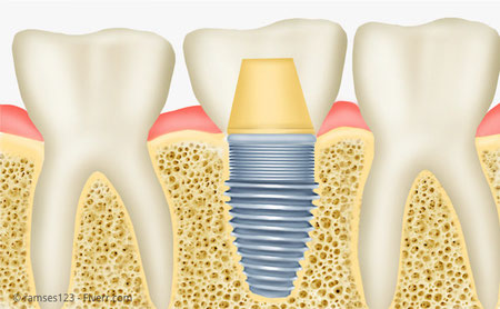 Implantat mit Krone: Die Nachbarzähne bleiben verschont