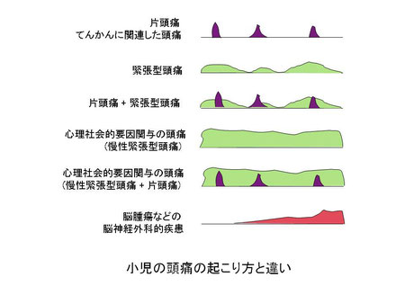 小児の頭痛の起こり方と違い