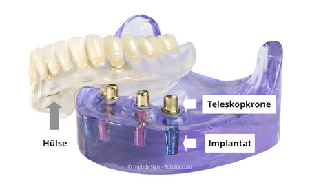 Implantate im Unterkiefer mit sog. Teleskopkronen, auf die der Zahnersatz aufgesteckt wird.