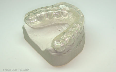 Sog. Aufbiss-Schiene, die Störkontakte zwischen den Zähnen ausgleicht und damit Zähneknirschen und -pressen verhindert.