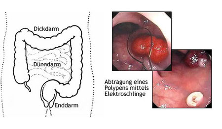 Koloskopie Praxis Pd Dr Med Daniel Kulling Gastroenterologie Endoskopie