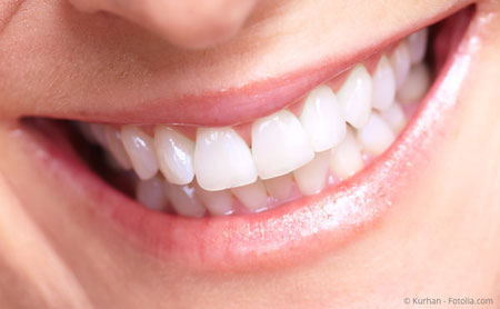 Deutlich sichtbar weißere Zähne mit Bleaching (Zahnaufhellung) beim Zahnarzt.