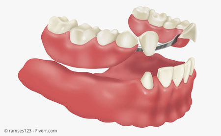 Herausnehmbarer Zahnersatz: Sog. Teleskopprothese