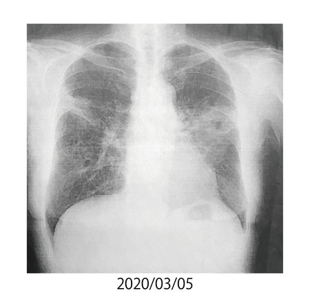 2020/3/5　肺の状態