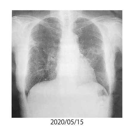 2020/05/15　肺の状態