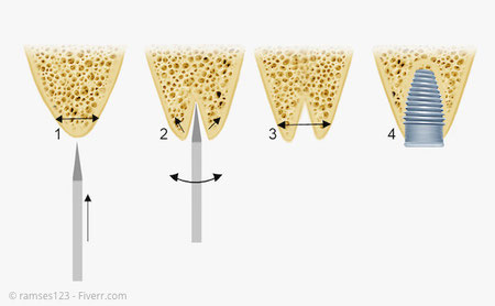 Bone Spreading: Ein zu schmaler Kiefer wird im Bereich des Implantats durch Spreizung verbreitert