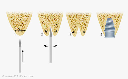 Bone Spreading: Ein zu schmaler Kieferkamm wird im Bereich des Implantats verbreitert