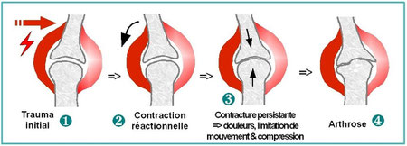 Mécanisme de l'arthrose