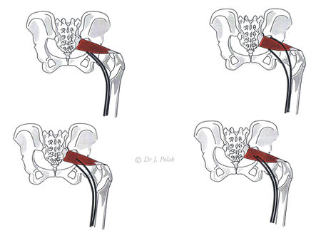 Variations anatomiques des rapports entre nerf sciatique et muscle Piriforme (Pyramidal)