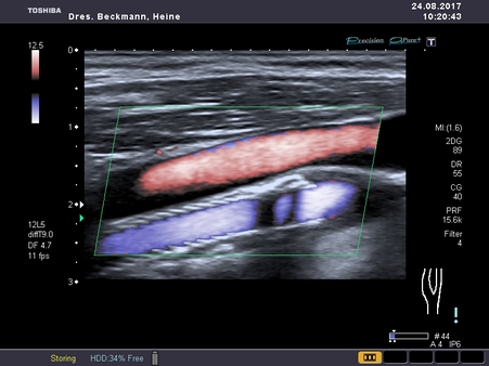 Stent in der Arteria carotis interna