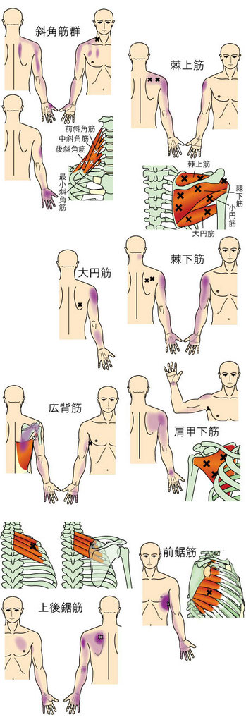 肘・前腕・手に痛みをもたらすトリガーポイント