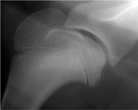 Radiographie d'une Ostéochondrite Disséquante de l'épaule - Source photo : Advétia