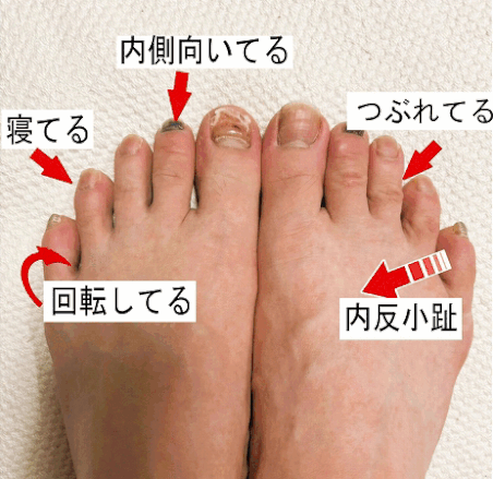 内反小趾にお勧めの靴下