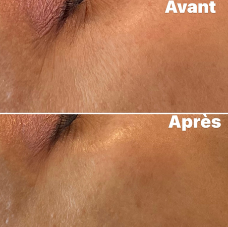 Résultats Avant/Après HIFU contour des yeux: lifting naturel où les ultrasons stimulent la production de collagène et élastine les semaines qui suivent la séance. Peau liftée, plus lumineuse et pores resserrés. Effets immédiats anti-âge et progressifs