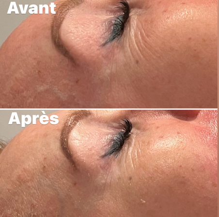 Résultats Avant/Après HIFU visage complet: lifting naturel où les ultrasons stimulent la production de collagène et élastine les semaines qui suivent la séance. Peau liftée, plus lumineuse et pores resserrés. Effets immédiats anti-âge et progressifs