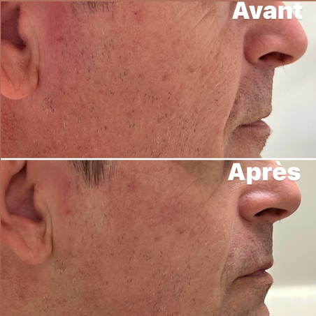 Résultats Avant/Après HIFU visage complet: lifting naturel où les ultrasons stimulent la production de collagène et élastine les semaines qui suivent la séance. Peau liftée, plus lumineuse et pores resserrés. Effets immédiats anti-âge et progressifs