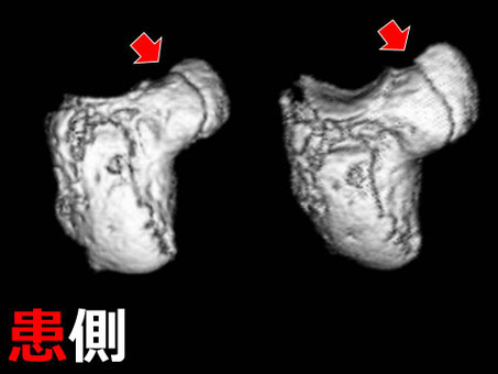 豊田市 接骨院 おおつか接骨院 有鈎骨鈎骨折 3D CT