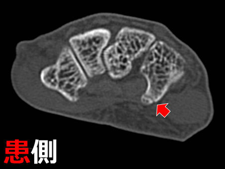 豊田市 接骨院 おおつか接骨院 有鈎骨鈎骨折 CT