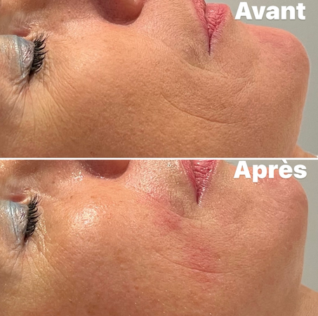 Avant/Après 1 séance HIFU visage complet: lifting naturel où les ultrasons stimulent la production de collagène et élastine les semaines qui suivent la séance. Peau liftée, plus lumineuse et pores resserrés. Effets immédiats anti-âge et progressifs