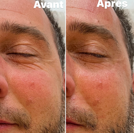 Avant/Après 1 séance HIFU visage: lifting naturel, rides lissées, peau lumineuse, effet tenseur immédiat, résultats visibles et progressif. Réactive la production naturelle du collagène et de l'élastine