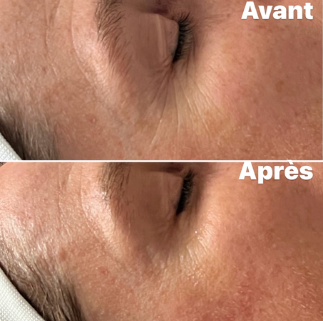 Résultats Avant/ Après HIFU contour des yeux: lifting naturel où les ultrasons stimulent la production de collagène et élastine les semaines qui suivent la séance. Peau liftée, plus lumineuse et pores resserrés. Effets immédiats anti-âge et progressifs