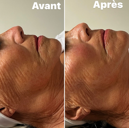 Résultats Avant/Après HIFU visage complet: lifting naturel où les ultrasons stimulent la production de collagène et élastine les semaines qui suivent la séance. Peau liftée, plus lumineuse et pores resserrés. Effets immédiats anti-âge et progressifs