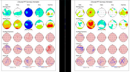 En cada fila se presentan diferentes características de la actividad eléctrica cerebral: potencia absoluta, potencia relativa, simetría, coherencia y fase.