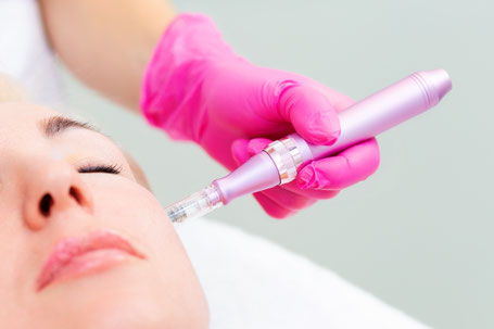 Medizinisches Microneedling mit Wirkstoff-Cocktails & Exosomen